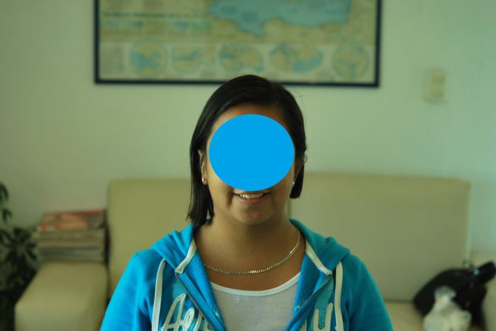 Microtia bilatera